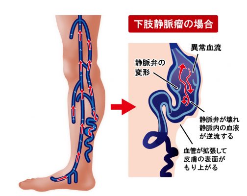 下肢静脈瘤の場合